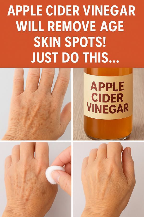 Apple Cider Vinegar: A Natural Remedy for Age Spots